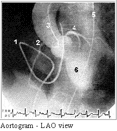 Angiogram